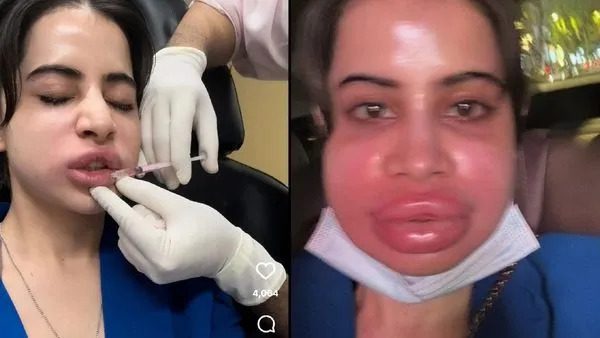 ಮಾದಕವಾಗಿ ಕಾಣಲು ತುಟಿ ಉಬ್ಬಿಸಿದ ಉರ್ಫಿ !!!! ಆದ್ರೆ ನಡೆದಿದ್ದೇ ಬೇರೆ: Urfi javed