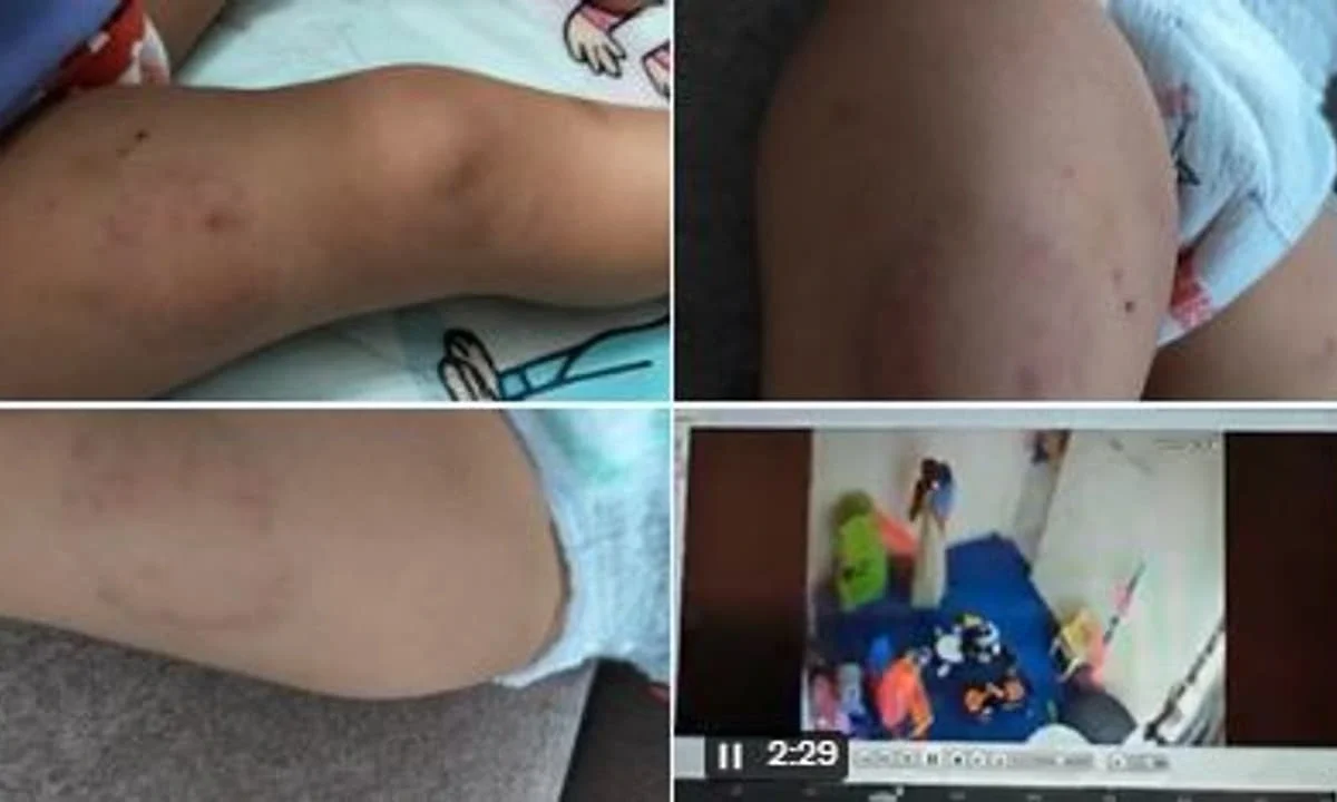 ಡೇ ಕೇರ್’ನಲ್ಲಿ 15 ತಿಂಗಳ ಮಗುವಿಗೆ ಕಚ್ಚಿ, ಹಲ್ಲೆ ನಡೆಸಿದ ಸಿಬ್ಬಂದಿ