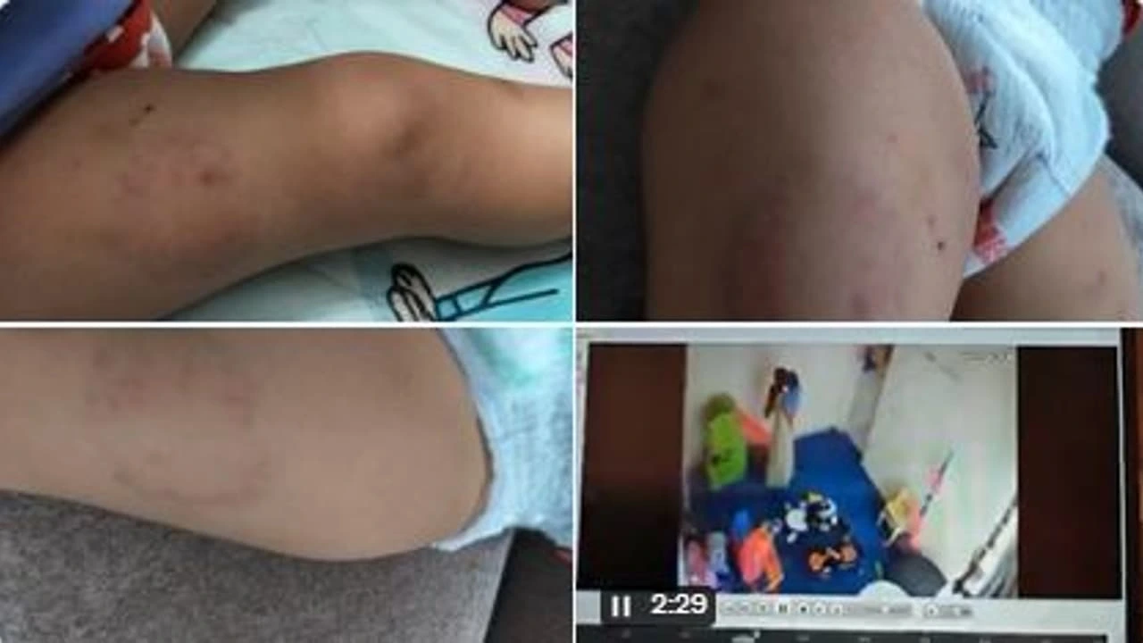  ಡೇ ಕೇರ್’ನಲ್ಲಿ 15 ತಿಂಗಳ ಮಗುವಿಗೆ ಕಚ್ಚಿ, ಹಲ್ಲೆ ನಡೆಸಿದ ಸಿಬ್ಬಂದಿ